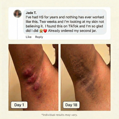 Flare & Boil Relief Balm