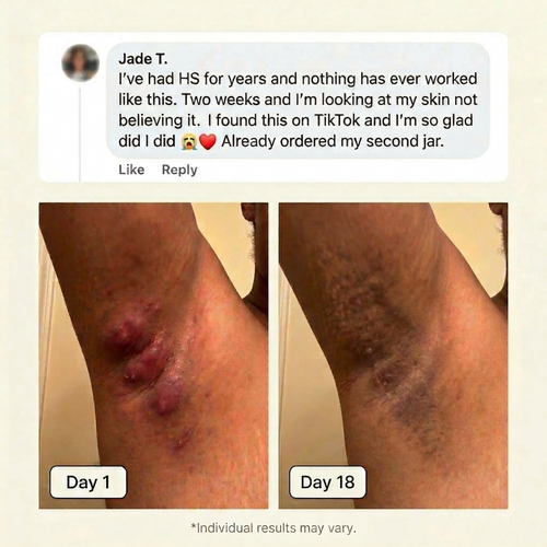 Flare & Boil Relief Balm