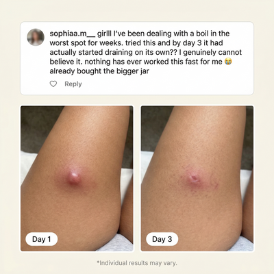 Flare & Boil Relief Balm