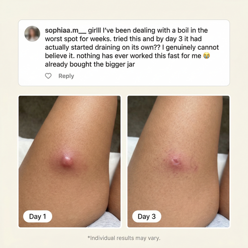 Flare & Boil Relief Balm