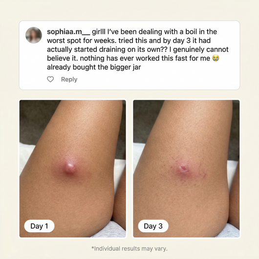 Flare & Boil Relief Balm