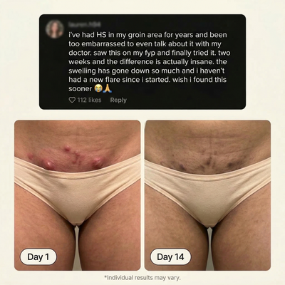 Flare & Boil Relief Balm