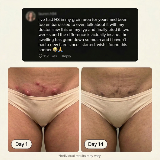 Flare & Boil Relief Balm